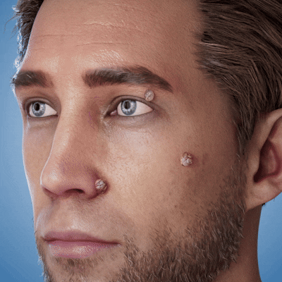✨TopSpire® 2-in-1 Microneedle & Hydrocolloid Patch | Targeted Solution for Raised Moles, Acne, Flat Warts & Skin Tags | Helps Improve the Appearance of Fine Lines, Scars & Skin Imperfections | Invisible Star Pimple Patches for Face & Body