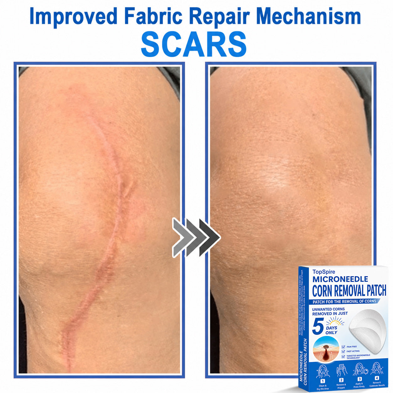 ✨TopSpire® 2-in-1 Microneedle & Hydrocolloid Patch | Targeted Solution for Raised Moles, Acne, Flat Warts & Skin Tags | Helps Improve the Appearance of Fine Lines, Scars & Skin Imperfections | Invisible Star Pimple Patches for Face & Body