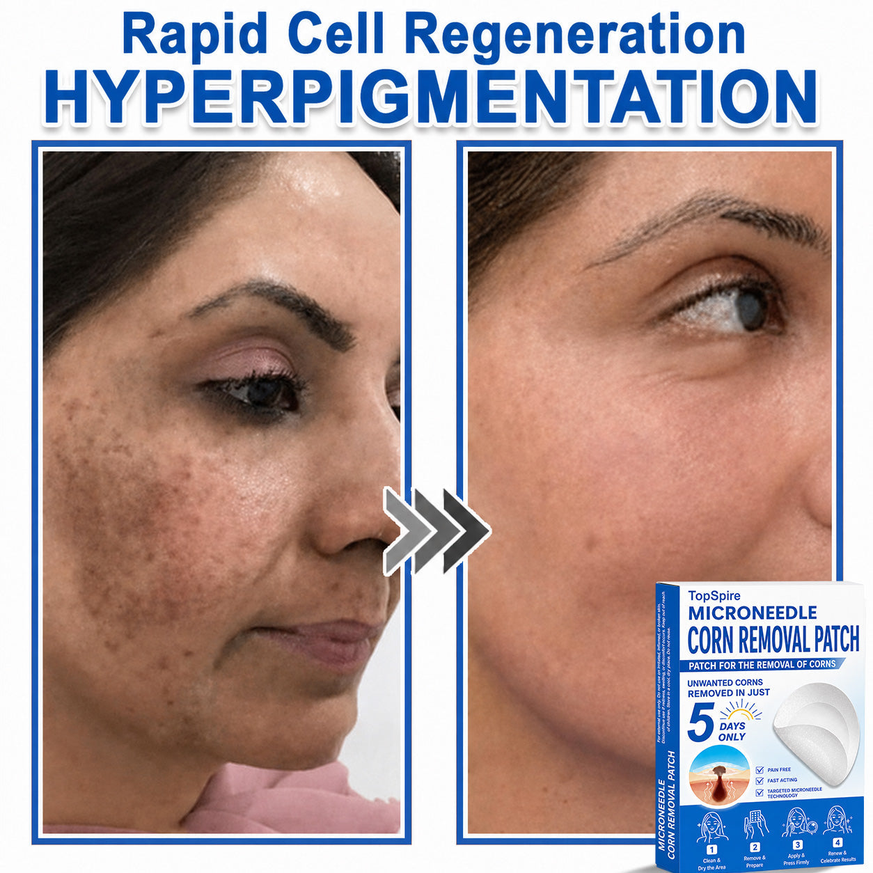 ✨TopSpire® 2-in-1 Microneedle & Hydrocolloid Patch | Targeted Solution for Raised Moles, Acne, Flat Warts & Skin Tags | Helps Improve the Appearance of Fine Lines, Scars & Skin Imperfections | Invisible Star Pimple Patches for Face & Body