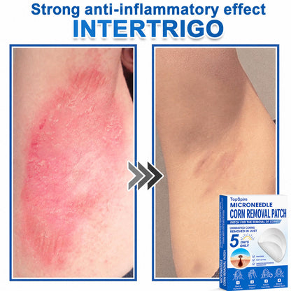 ✨TopSpire® 2-in-1 Microneedle & Hydrocolloid Patch | Targeted Solution for Raised Moles, Acne, Flat Warts & Skin Tags | Helps Improve the Appearance of Fine Lines, Scars & Skin Imperfections | Invisible Star Pimple Patches for Face & Body